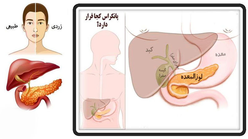 سرطان معده