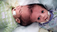 ساعت ها عمل روی لاله و لادن برزیلی / سرنوشت زیبای این 2 نوزاد+عکس