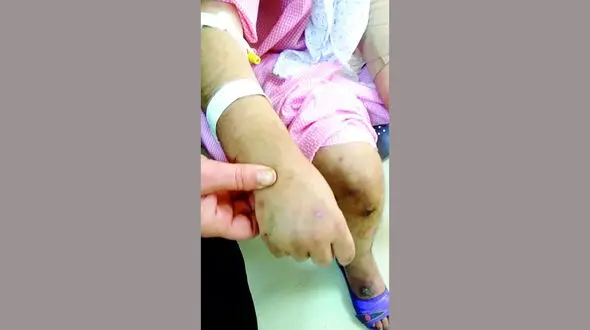 عکس دلخراش از دختربچه سیرجانی که شکنجه شده است / ارثیه مادری شوم بود؟