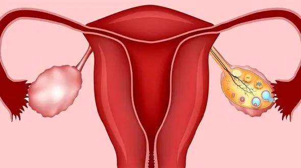 تنبلی تخمدان چه عوارضی دارد؟