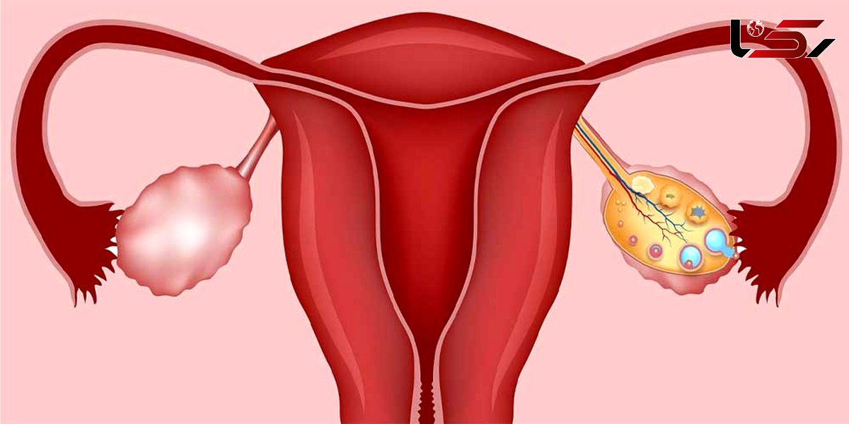 تنبلی تخمدان چه عوارضی دارد؟