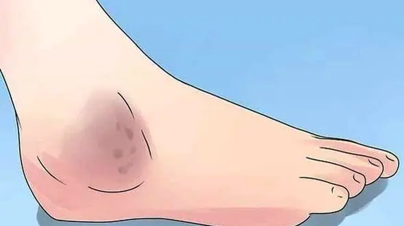 ورم پا + دلایل ایجاد 