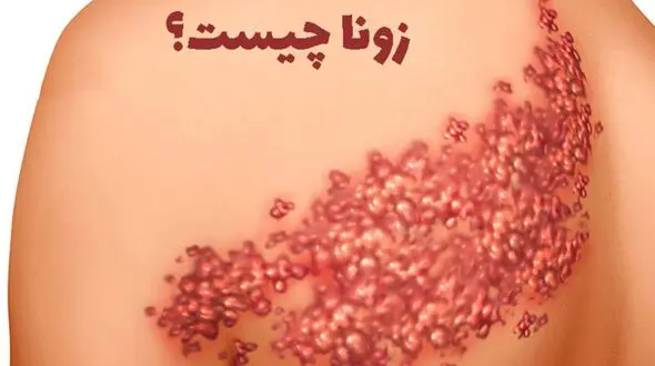زونا چیست؟ + جدول سنی مبتلا شدن به زونا