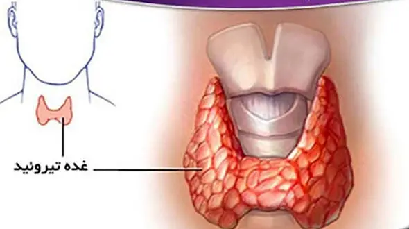 تیروئید چیست و چه علائمی دارد؟ / جدول های کامل درباره پرکاری و کم کاری تیروئید