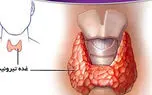 تیروئید چیست و چه علائمی دارد؟ / جدول های کامل درباره پرکاری و کم کاری تیروئید