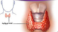 تیروئید چیست و چه علائمی دارد؟ / جدول های کامل درباره پرکاری و کم کاری تیروئید