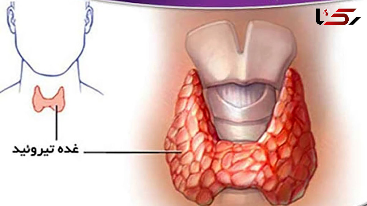 تیروئید چیست و چه علائمی دارد؟ / جدول های کامل درباره پرکاری و کم کاری تیروئید