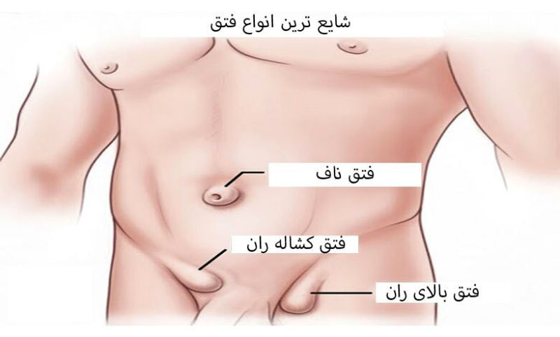 انواع فتق