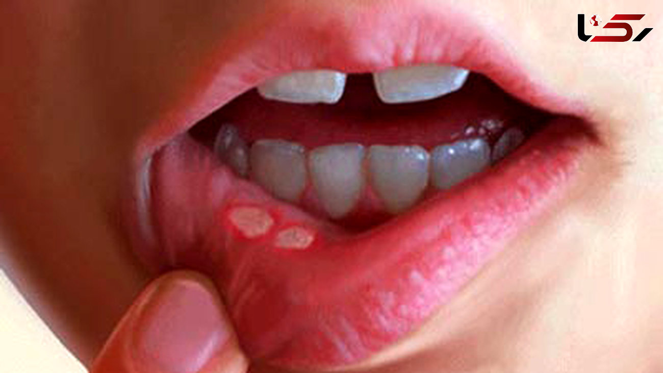 درمان آفت های دهانی با طی سنتی و خانگی ساده 