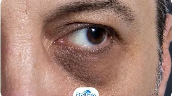 ۴ نشانه کبد چرب در چهره که از آن بی خبرید!