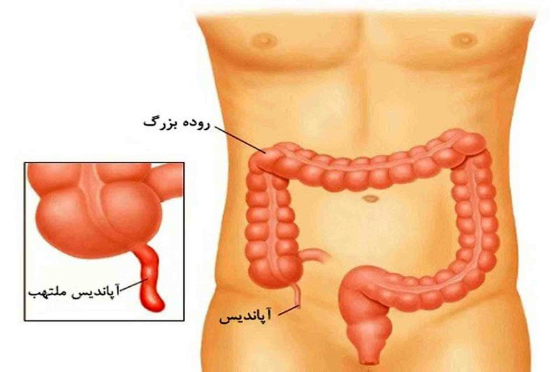 جای آپاندیس