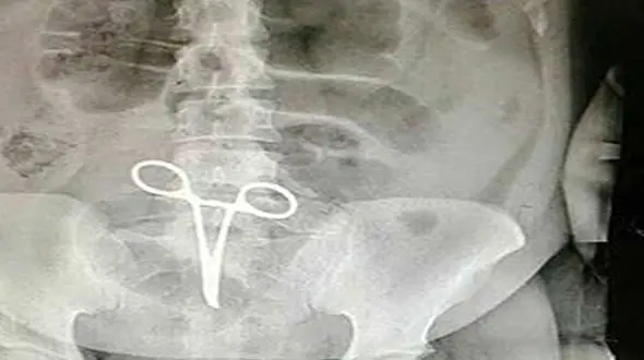 وقتی پنس داخل شکم یک بیمار اردستانی جا ماند + عکس