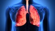 آمبولی ریه چیست ؟