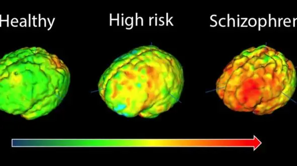 ابتلا به اسکیزوفرنی قبل از تولد شکل می‌گیرد