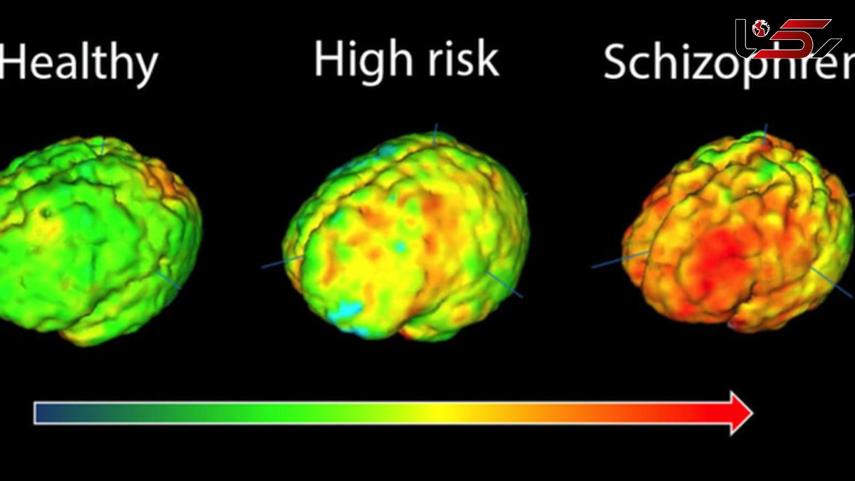 ابتلا به اسکیزوفرنی قبل از تولد شکل می‌گیرد