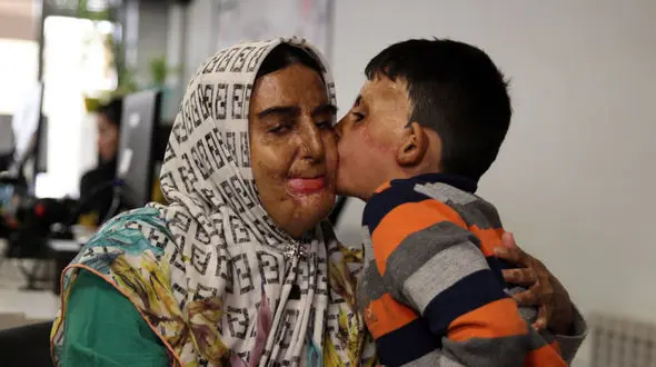 فریادهای جانسوز مادر و پسر در شعله های آتش / برای عمل چهره های سوخته کمکمان کنید + فیلم گفتگو و جزییات