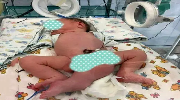 تولد نوزاد 3 پا در روسیه + عکس