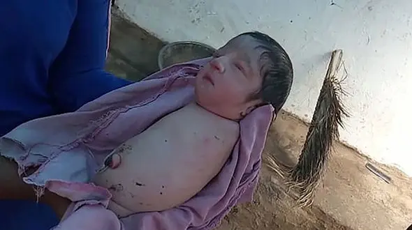 عکس / تولد نوزاد عجیب الخلقه / هیچ آینده ای در انتظار این کودک نیست 