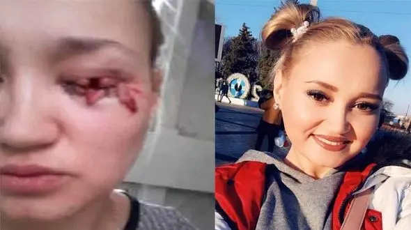 فیلم لحظه حمله سگ ولگرد به دختر جوان + عکس قبل و بعد از گازگرفتگی 