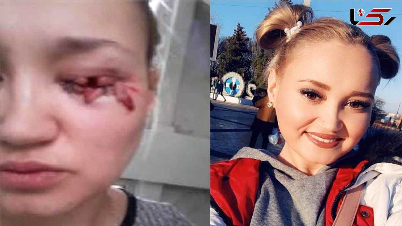 فیلم لحظه حمله سگ ولگرد به دختر جوان + عکس قبل و بعد از گازگرفتگی 