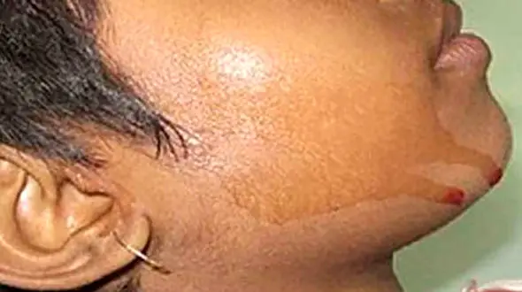 دختری که خون عرق می کند! +عکس 