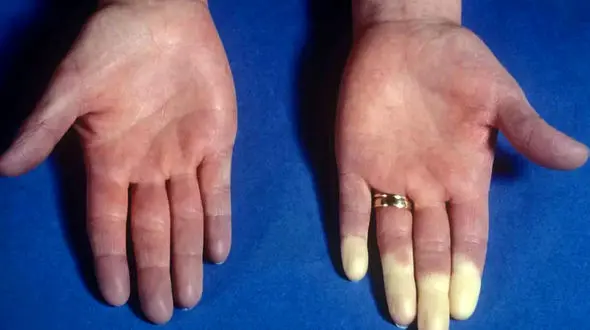 سردی هر عضو بدن نشانه چه بیماری است؟