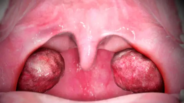 سنگ لوزه و درمان‌ های موثر + علت تشکیل 