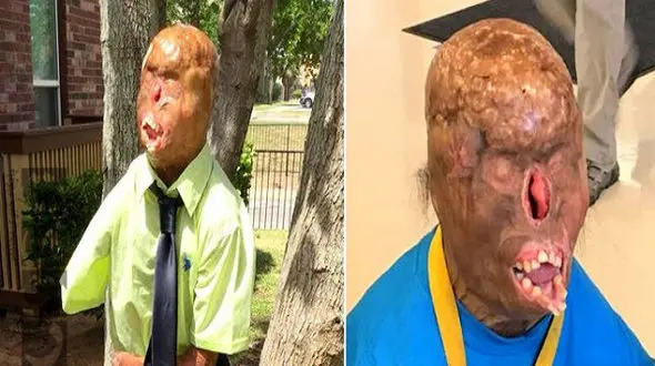 این چهره وحشتناک یک جوان 16 ساله است / افتادن شمع در تختخواب او را به این روز درآورد +عکس 14+