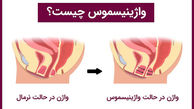 واژینیسموس چیست؟ / جدول درمان واژینیسموس و مزایا و معایب