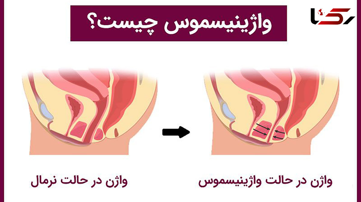 واژینیسموس چیست؟ / جدول درمان واژینیسموس و مزایا و معایب