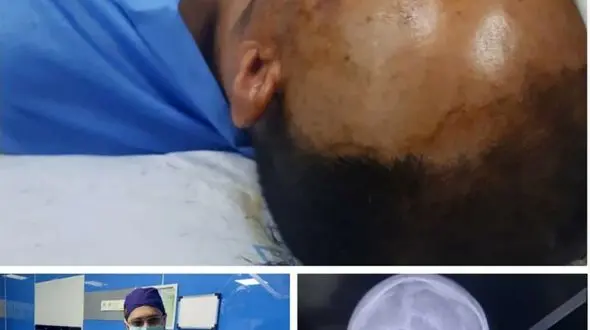 عکس فجیع از فرو رفتن سیخ کباب در جمجمه مرد مشگینی 