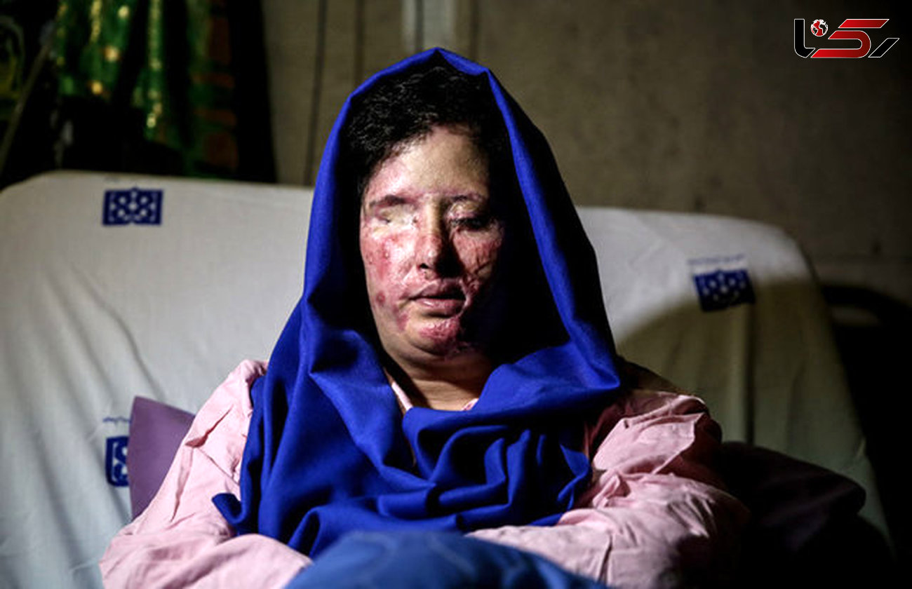  نجات از نابینایی"سهیلا جورکش" قربانی اسیدپاشی های اصفهان