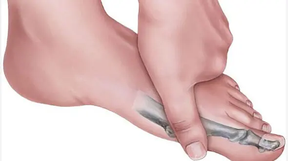 دلایل شایع التهاب مفصلی در انگشتان پا