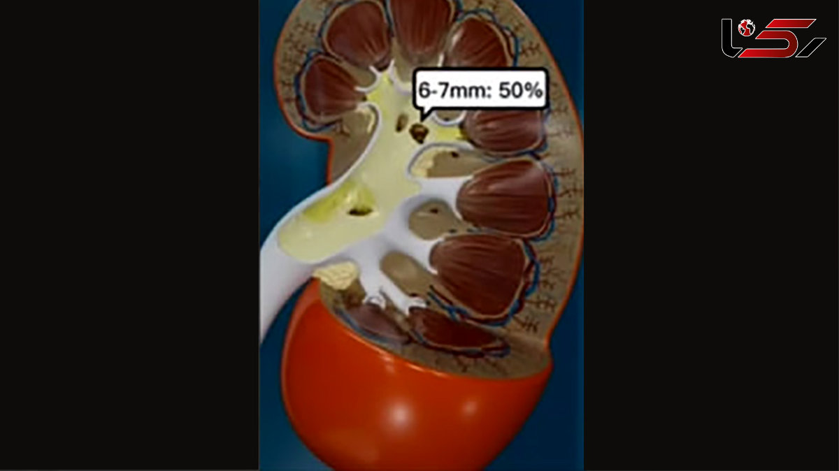 نحوه تشکیل سنگ کلیه به زبان فیلم