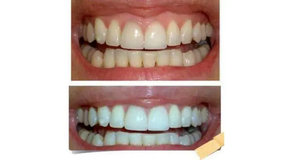 برای داشتن دندان هاى سفید چیکار کنیم ؟