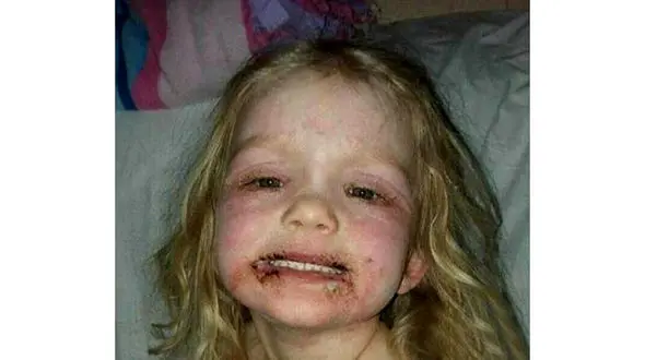  لوازم آرایشی صورت دختری را زشت کرد / این دختر بستری شد! + عکس ها
