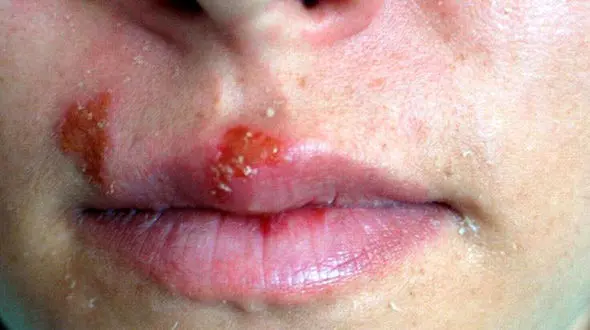 ترفندهای خانگی درمان تبخال