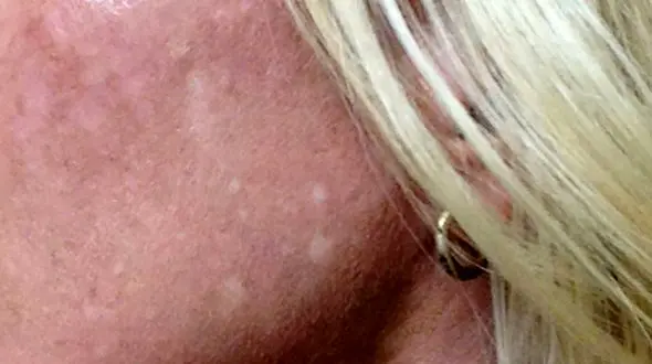 لک سفید روی پوست نشانه چیست؟