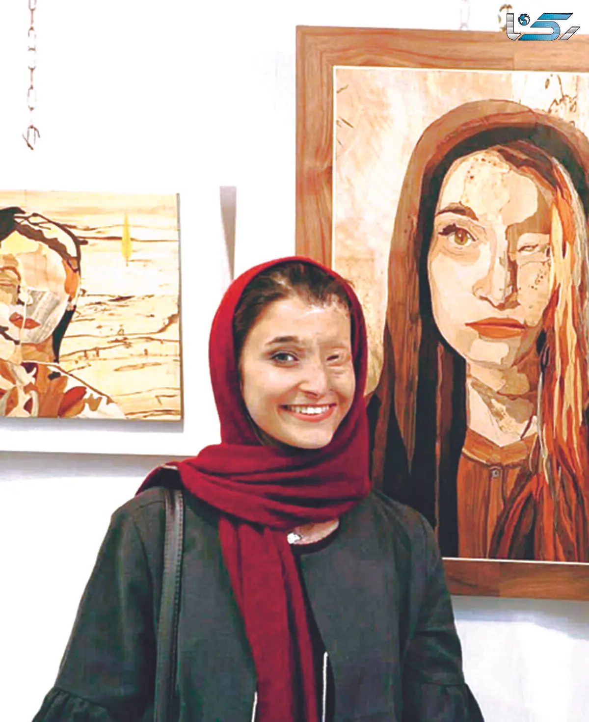 گفتگو با مرضیه / بعد از سوختن چهره ام عشقم را از دست ندادم! + عکس تاثیرگذار