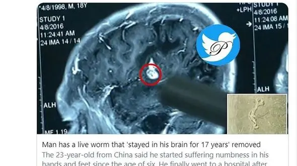 زندگی با کرم  12.7 سانتی متری در مغز به مدت 17 سال + عکس
