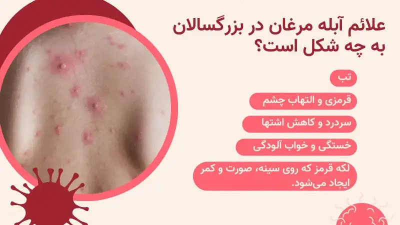 آبله مرغان در بزرگسالان