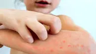 نکات مهم درباره آبله‌ مرغان و زونا در کودکان