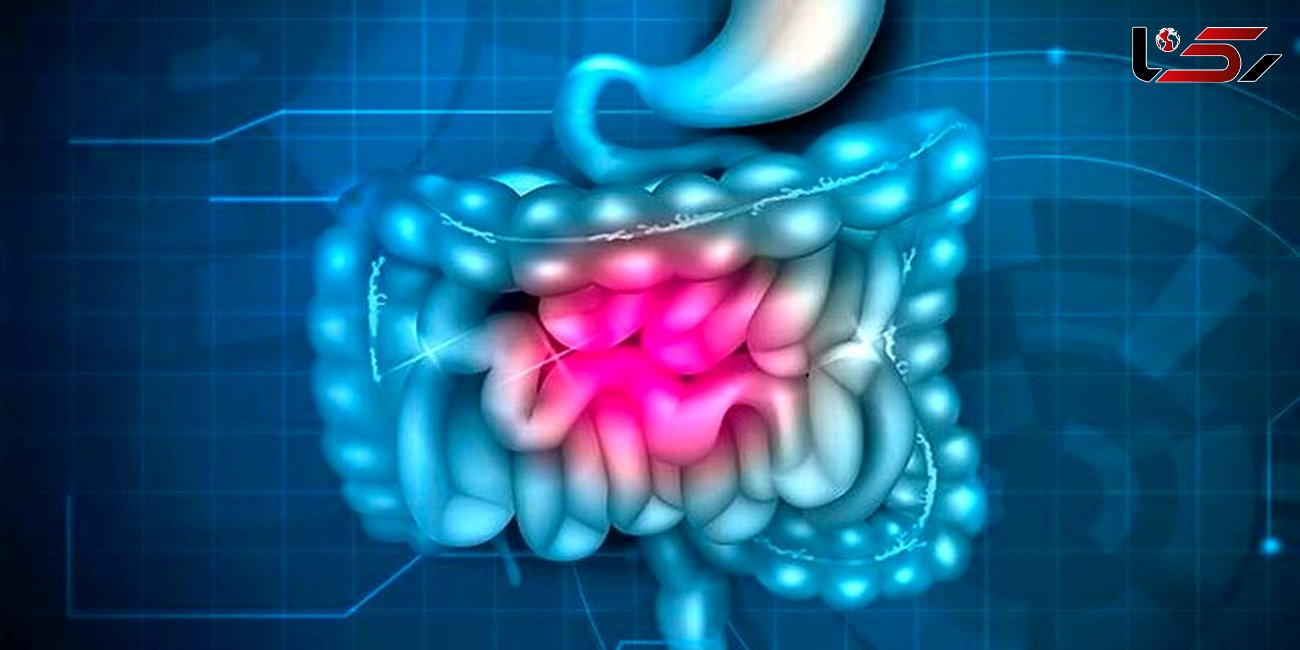 چسبندگی روده می تواند باعث پارگی روده شود