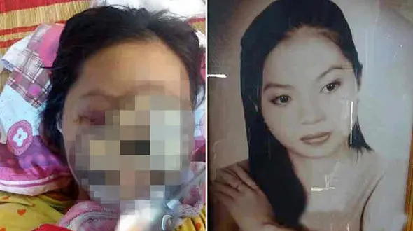  عفونت سینوس چهره بازیگر جوان را از بین برد+ عکس