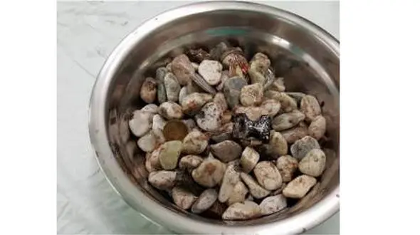 خارج کردن یک  کاسه سنگ از شکم مرد استرسی+عکس