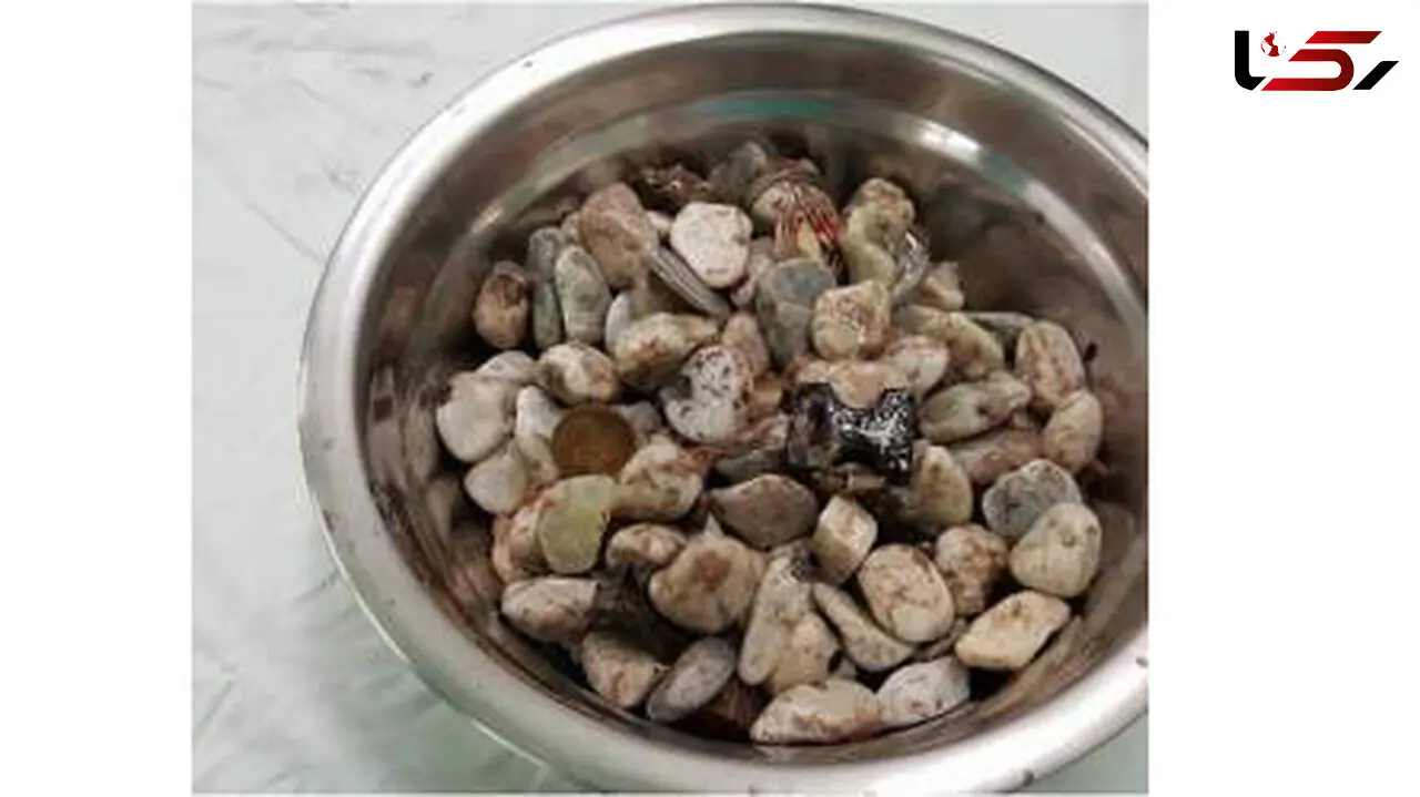 خارج کردن یک  کاسه سنگ از شکم مرد استرسی+عکس