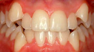 راهکارهای موثر در پیشگیری از کج شدن دندان کودکان