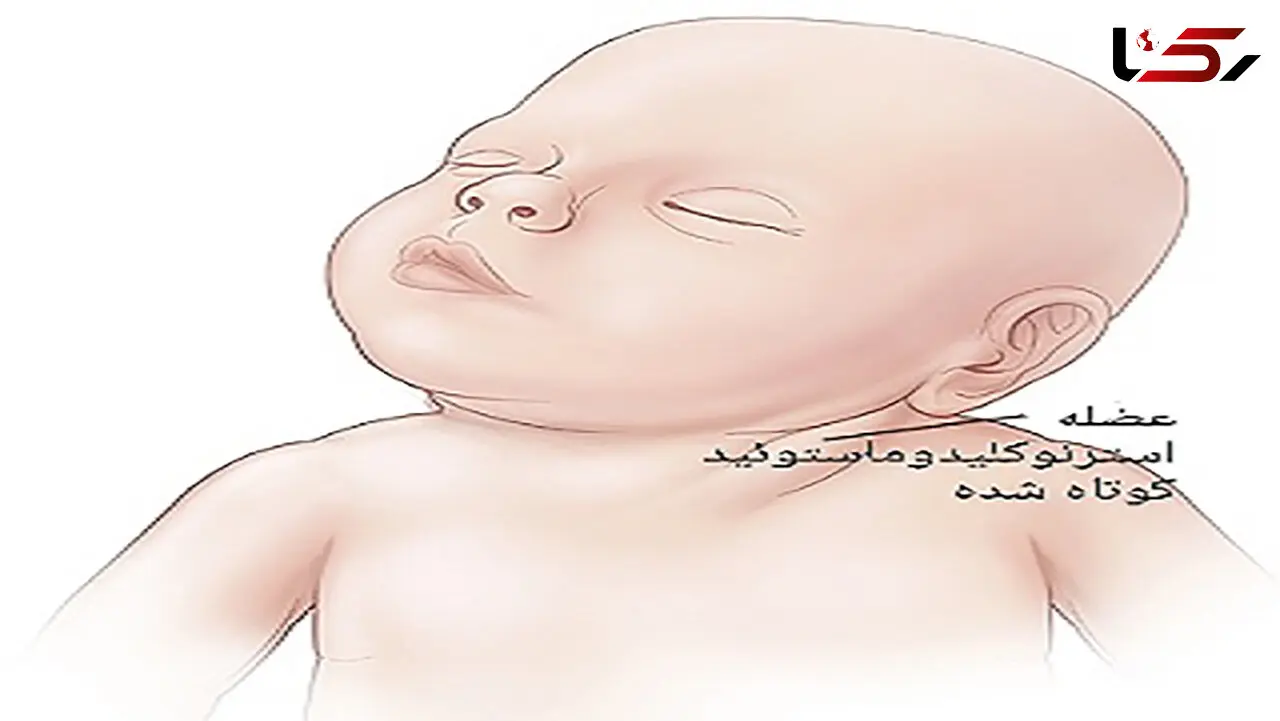 خطر گردن کج در کودکان + عکس های درمان 