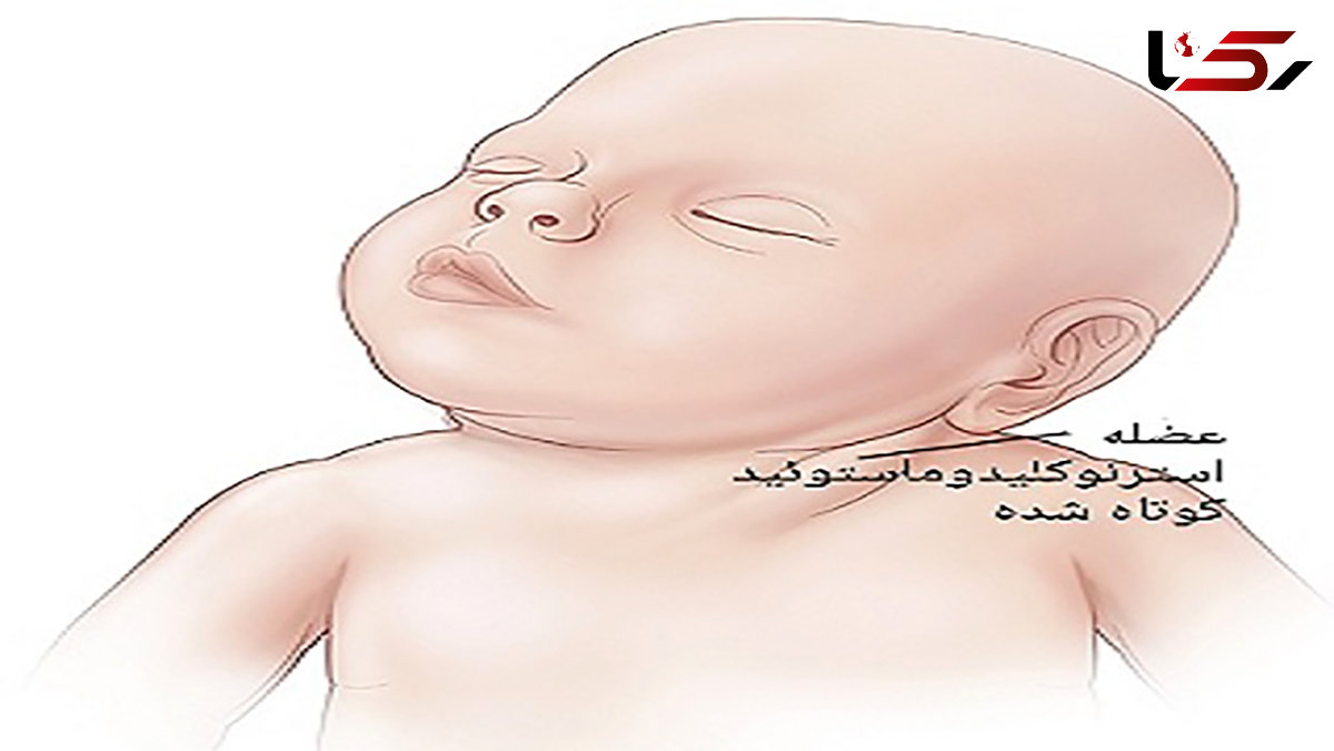 خطر گردن کج در کودکان + عکس های درمان 