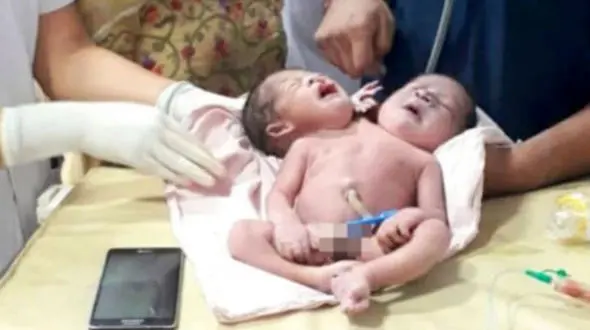 تولد نوزاد عجیب الخلقه در هند + عکس